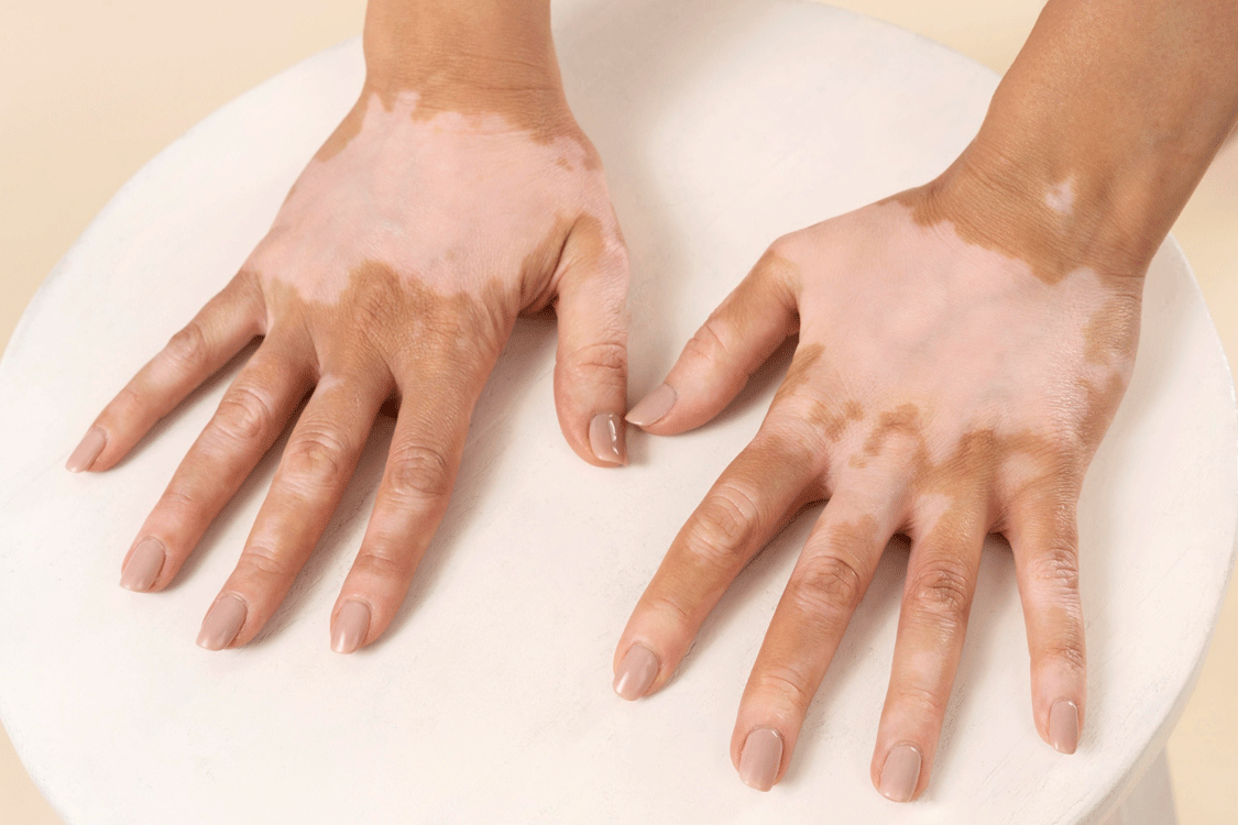 Vitiligo Nedir