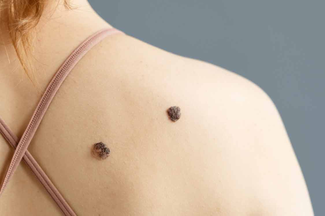 Et beni neden çıkar