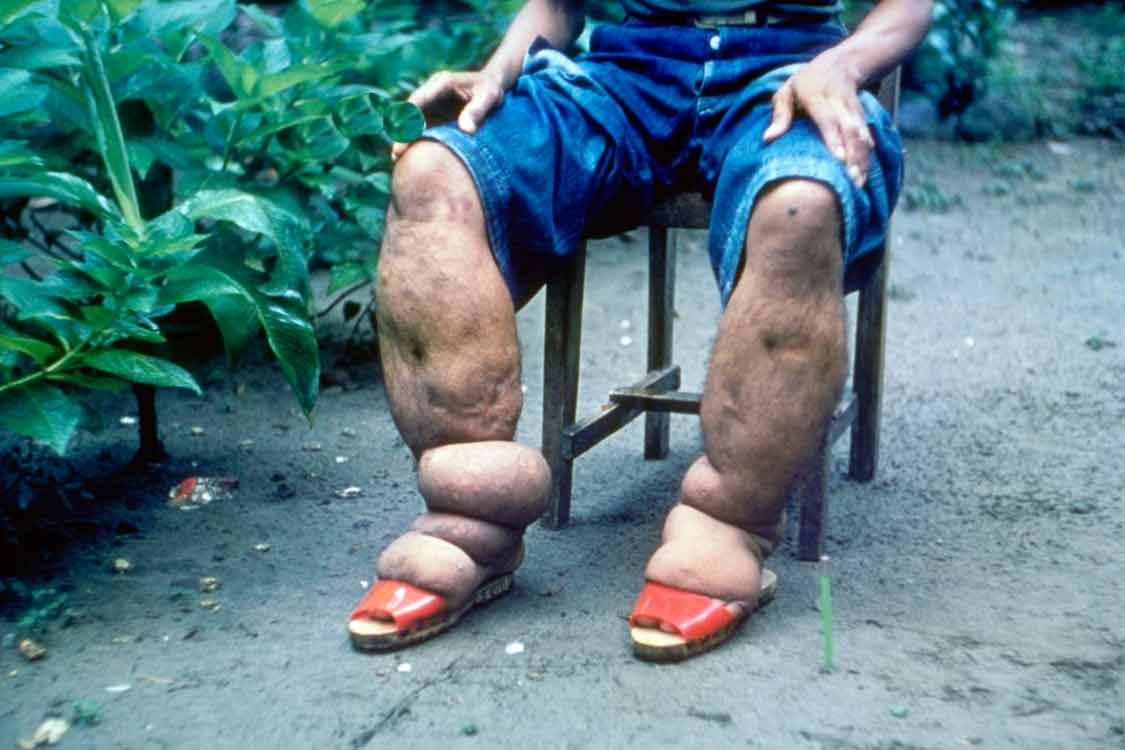 Fil hastalığı lenfödem